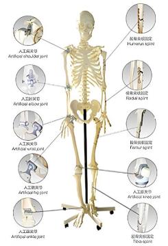 Model of human skeleton with artificial joints and splint fixation