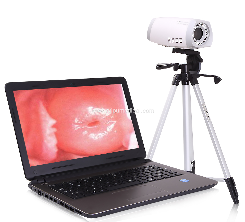 Medical Digital Portable Video Colposcope for Gynecology