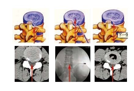 Pldd/Spine Surgery Laser