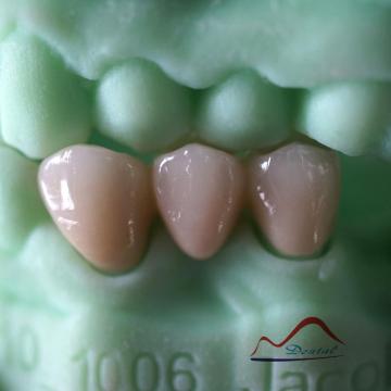 Multilayer High Translucent Zirconia Bridge