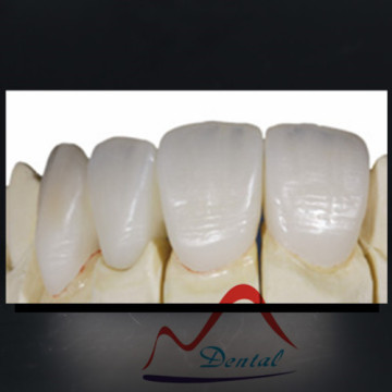 Dental Empress All Ceramic Crown and Bridge