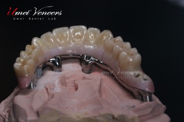 Robust zirconia planted bridges