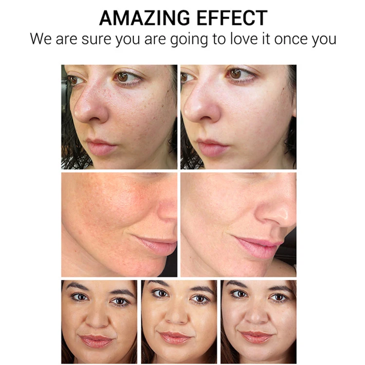 Powerful Whitening Freckle Cream Remove Melasma Acne Spots Pigment Melanin Dark Spots Face Care Cream