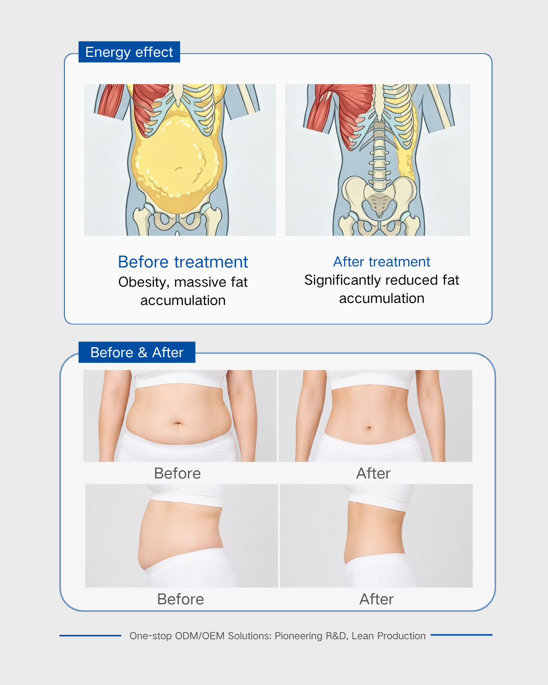 Derin Karın İçin Odaklanmış Ultrason Dönüştürücü Focused Ultrasound Transducer for Deep Abdomi
