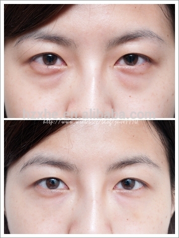 anti-wrinkle Properties hyaluronic acid FOR crow's feet eye wrinkle