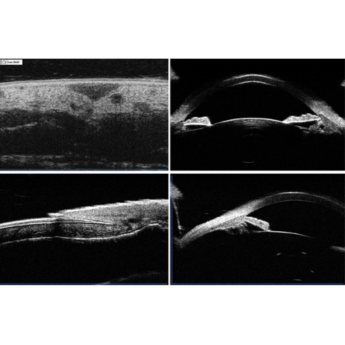 Scanner Pachymètre ophtalmique A-Scan