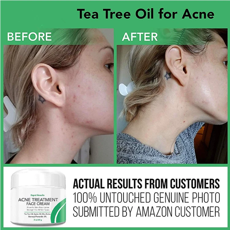 Natural Acne Treatment Face Cream Hormonal & Cystic Acne Pimple Cream
