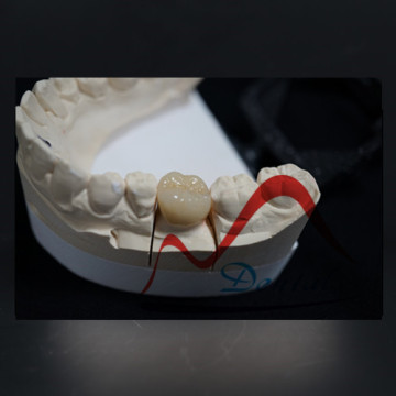 Ceramic alternative, IPS E-max All Ceramic Crown