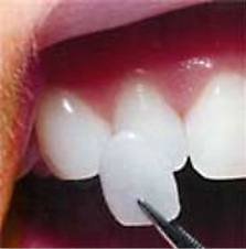 Natural Teeth Cosmetic Dental Veneers Of Dental Laboratory For Periodontal Health