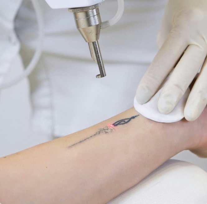 Machine de déménagement de tatouage laser au laser nanoseconde Choicy