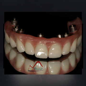 Dental Hybrid Implant Denture