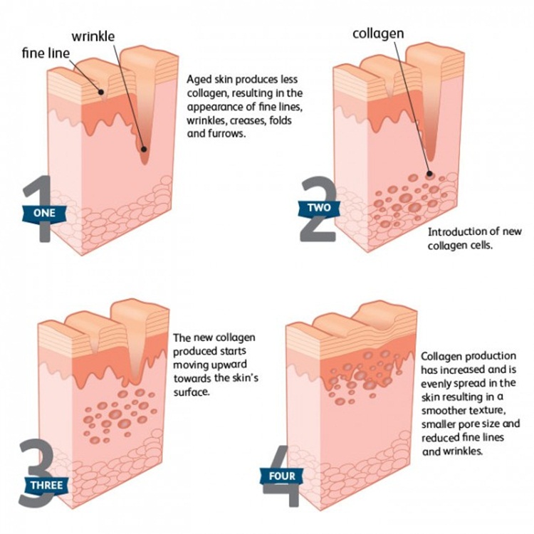 Free Shipping Dermal Filler