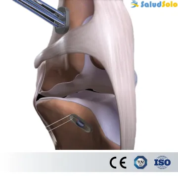 Medical Artificial Ligament System
