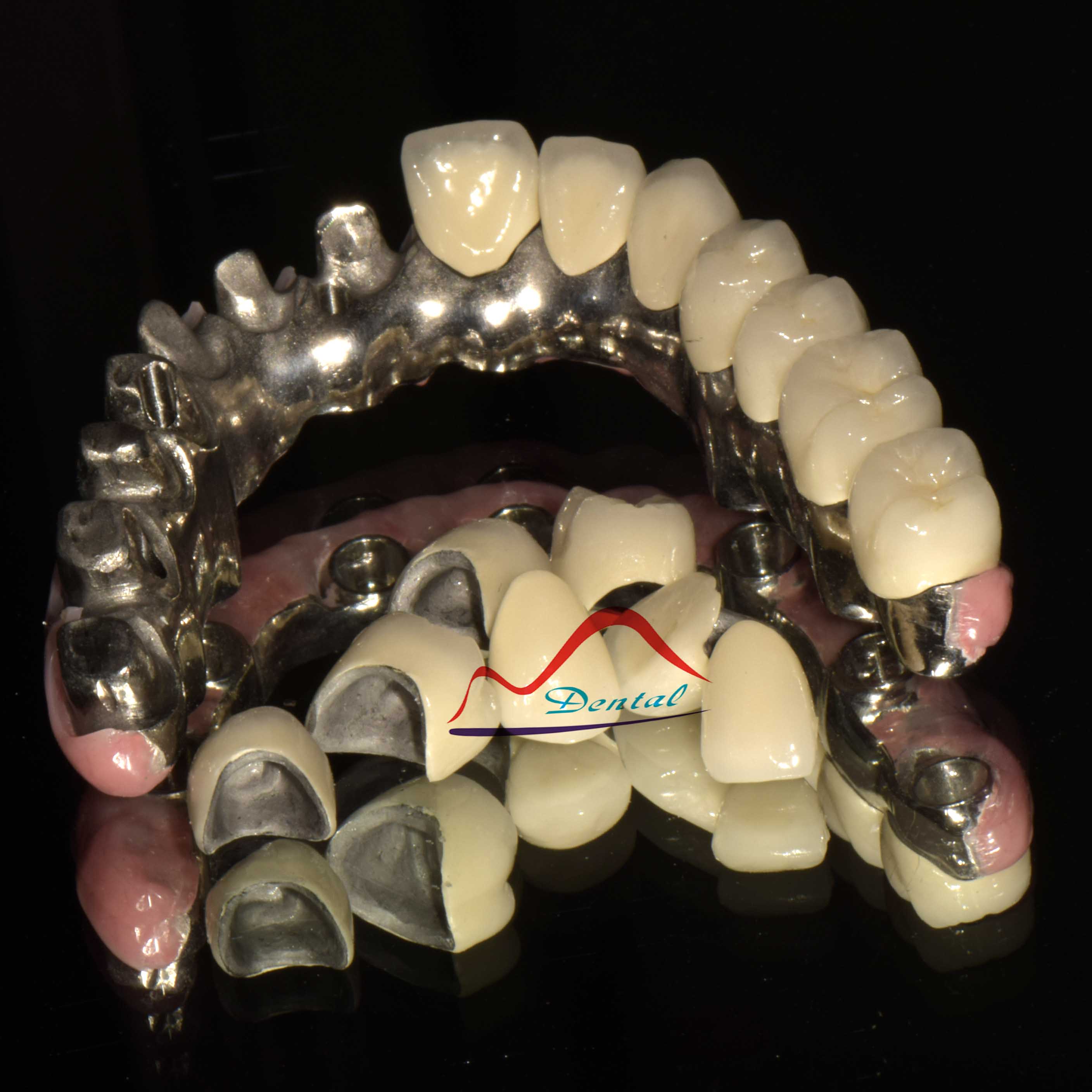 Screwed Implant Malo Bridge d