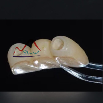 Dental Zirconia CAD/CAM Restorations