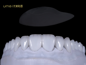 E.max layered veneers