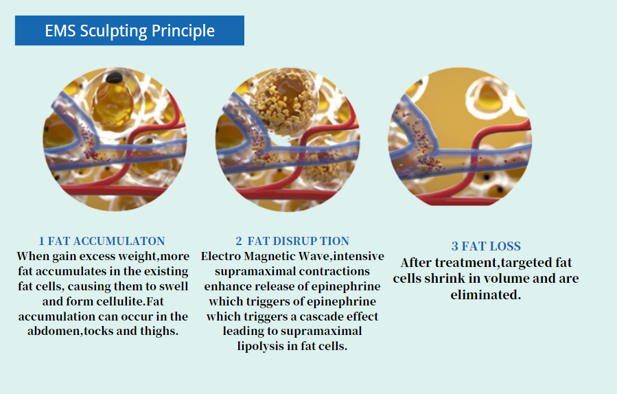 EMS Sculpting Principle