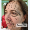 Before and after plla dermal fillers