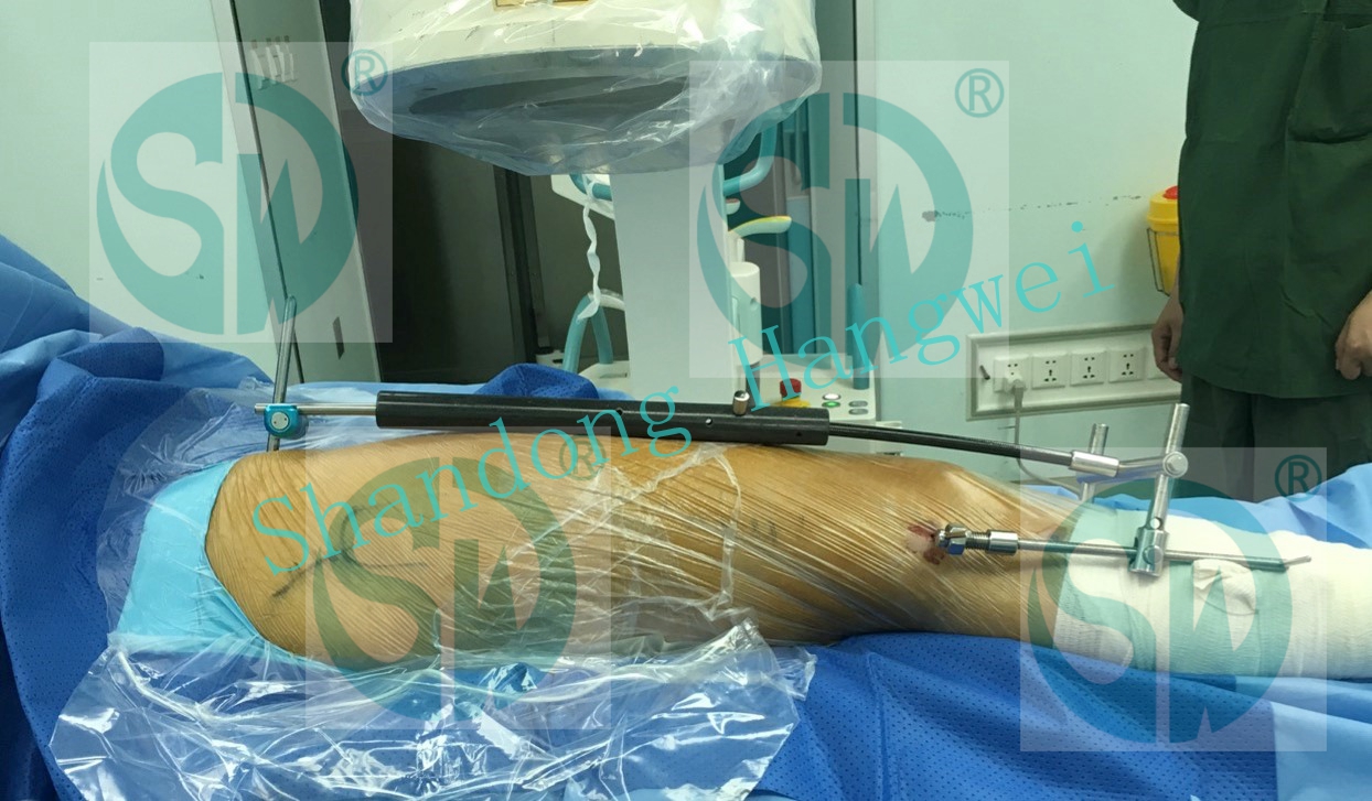bingkai traksi minimal invasif minimally invasive traction frame