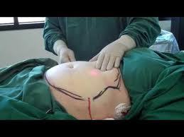 Laser Liposuction