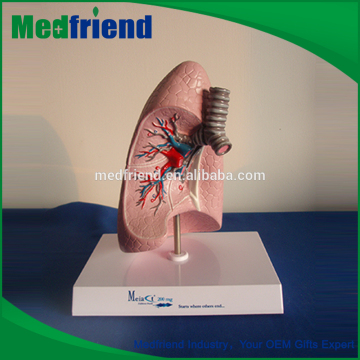 MFM024 China Wholesale Merchandise Lung Disease Model