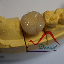 Lithium Delicate Ceramic IPS Emax Crown and Bridge