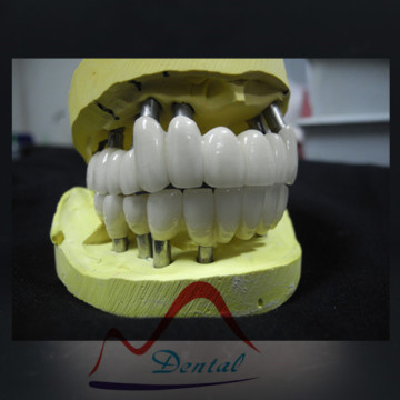 Cementable Dental Implant Bridge