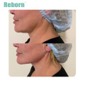 Injectable Hyaluronic Acid Filler for Face