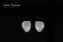 Strong cast porcelain veneers