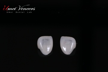 Strong cast porcelain veneers