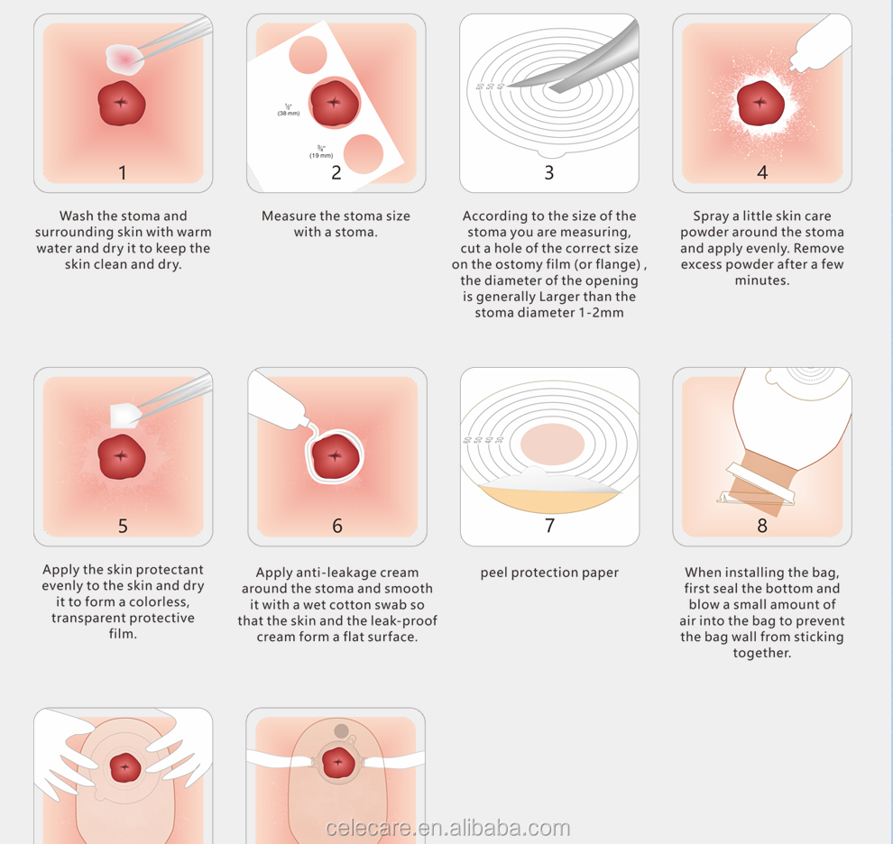 2ピースOSTOMYバッグポーチシステムストーマOSTOMY COLOSOSOMYバッグ