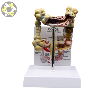 Advanced Diseased Large Intestines Model for Medical Education
