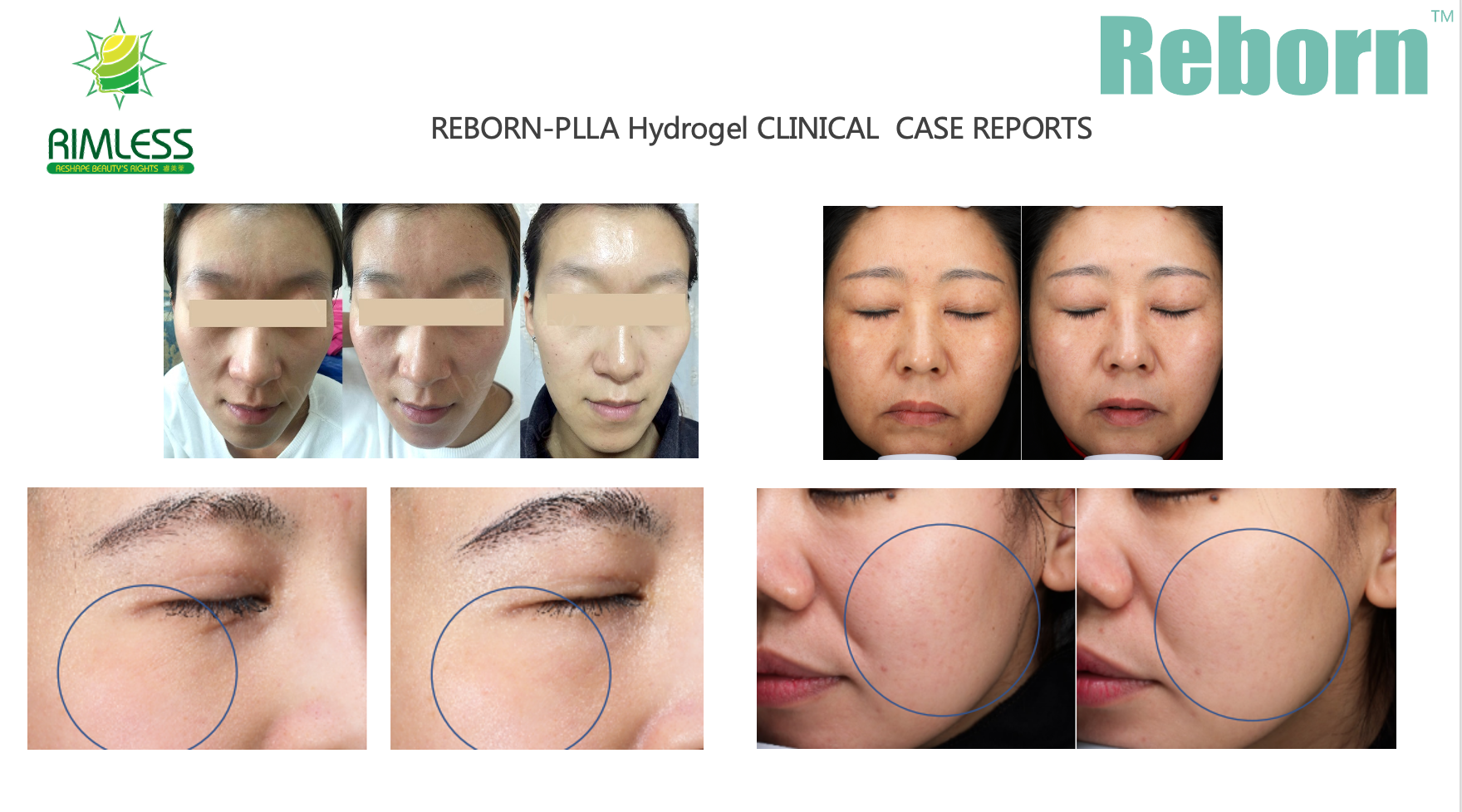 Reborn PLLA Cosmetic Gel For Face - Plumps & Hydrates