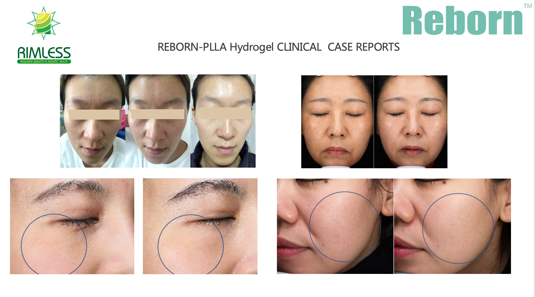 2ml 5ml Reborn plla hydrogel for removing the melanin in the body