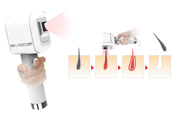 Pistola de depilación láser Laser Hair Removal Gun