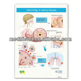 3D Medicinal Chart - Children Bronchial Asthma Disease