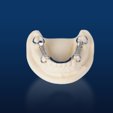 Custom Metal Partial Denture