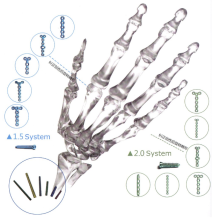 2.0 Mini Locking Plate