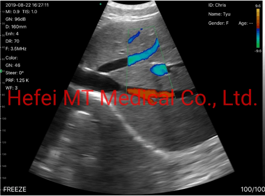 Ultrasound Cardaic Phased Array Wireless Ultrasound Probe