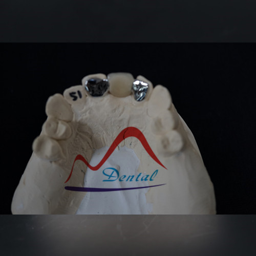 Dental Aesthetic Maryland PFM Bridge