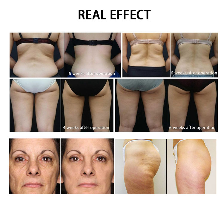 Hifu Treatment Reviews Hifu Treatment Reviews