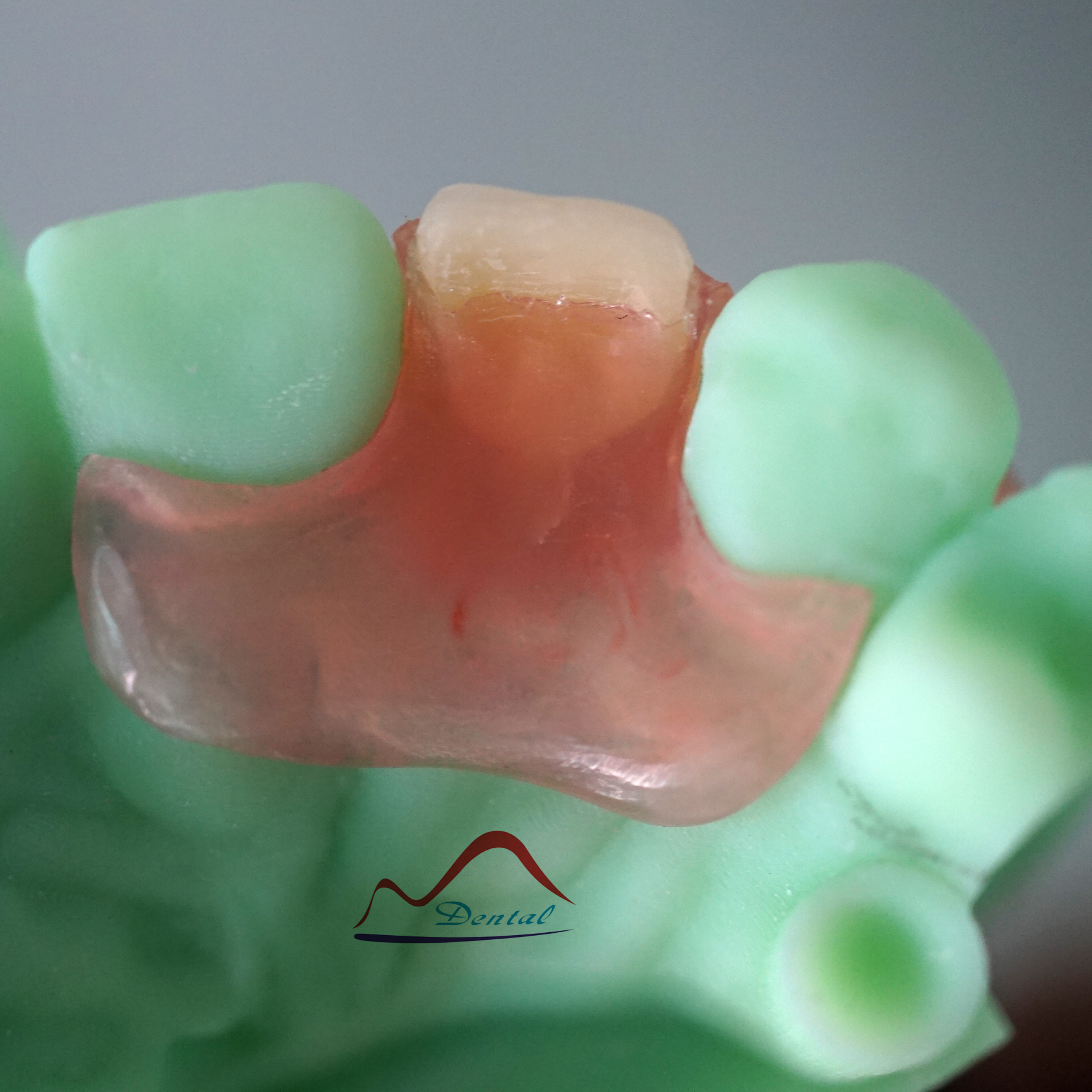 Valplast Denture On 3D Printing Model (2)