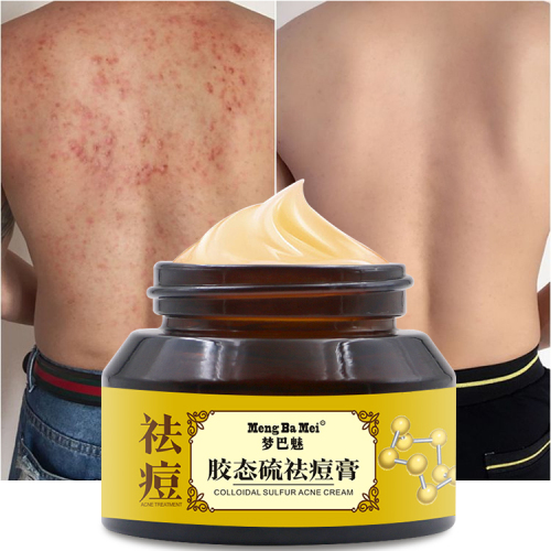 Anti Acne Cream Colloidal Sulfur Acne Cream