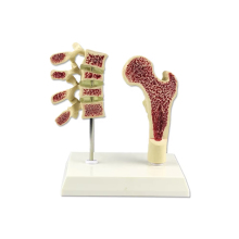 Medical Science Osteoporosis Human Bone Model for Doctors on Desktop