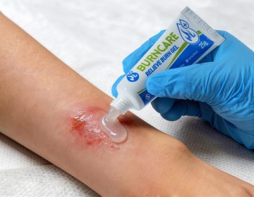 Burn Gel Dressing