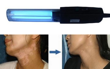 UV Lamps - Vitiligo, Psoriasis, Eczema, Atopic Dermatitis