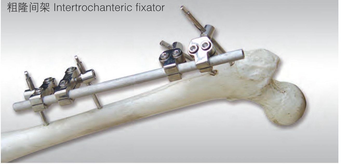 fixator intertrochanteric intertrochanteric fixator