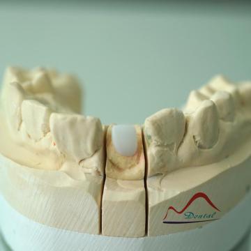 CAD/CAM Digital Zirconia Post and Core