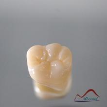 Molar Full Zirconium Restoration