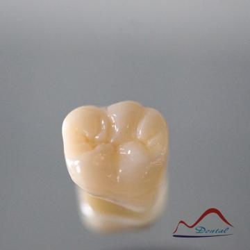 Molar Full Zirconium Restoration
